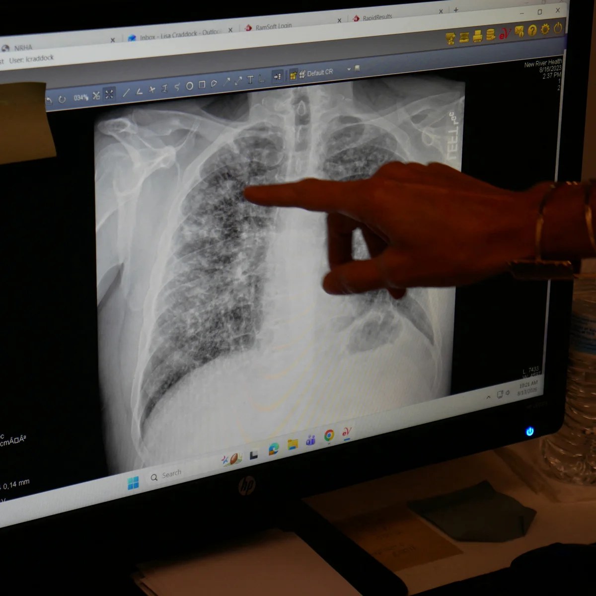 We know how to prevent black lung, so why are workers still dying?